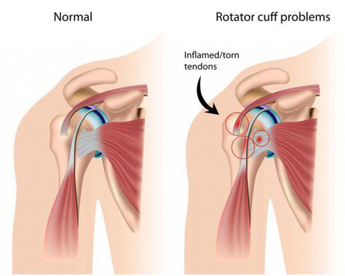 Symptoms of Shoulder Tendonitis