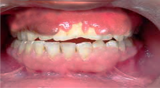 Drug-Induced Gingival Hyperplasia