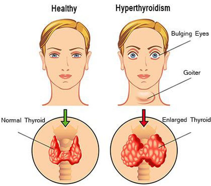 Hyperthyroidism