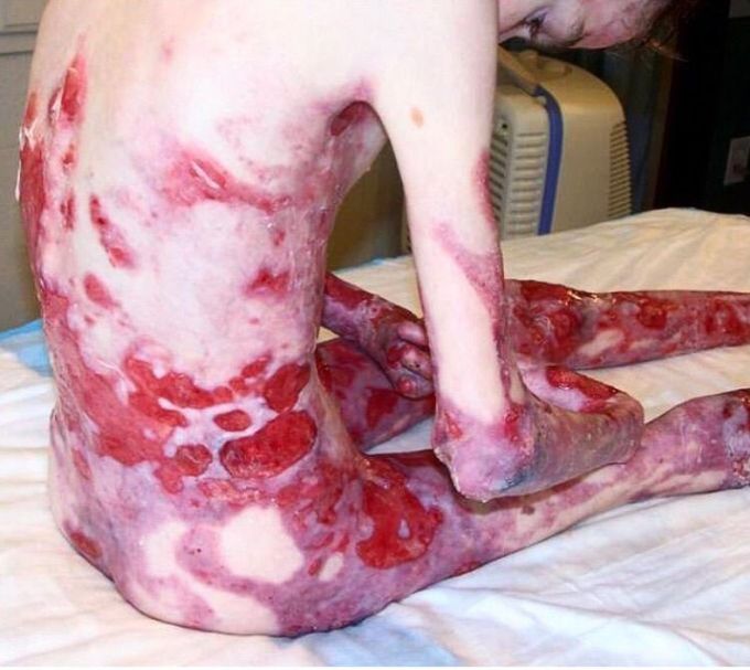 Epidermolysis bullosa simplex