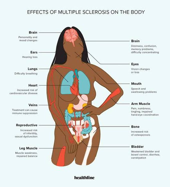 Symptoms of multiple sclerosis