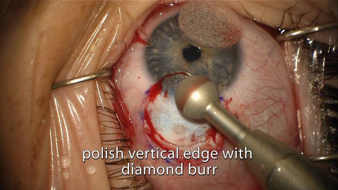 Limbal Dermoid Removal