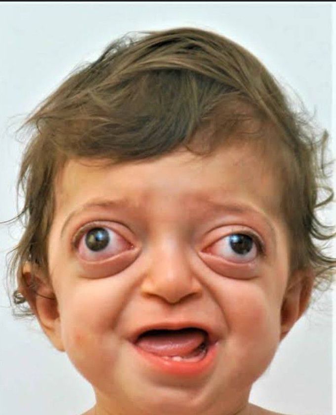 Crouzon Syndrome