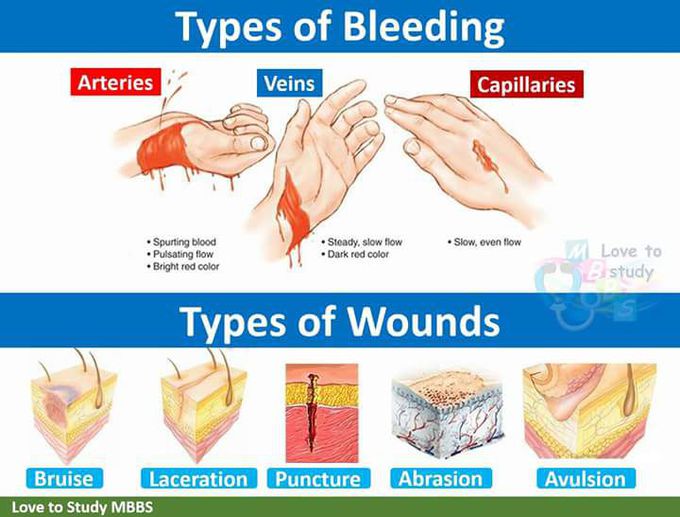 Types of bleeding and wound.