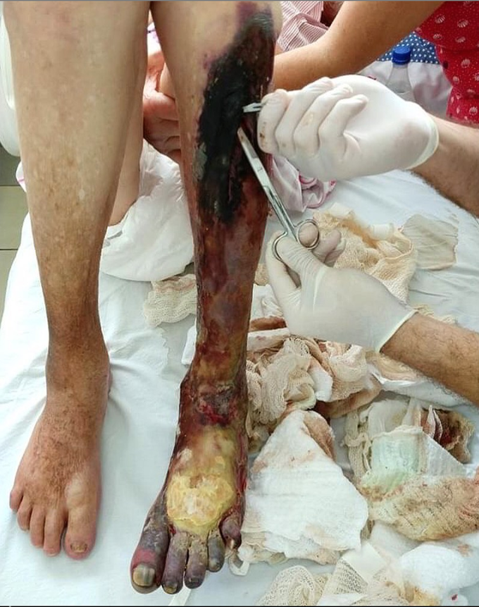 Chronic arterial thrombosis of the lower extremity!!