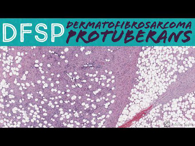 Microscopic study of (Dermatofibrosarcoma protuberans - DFSP)