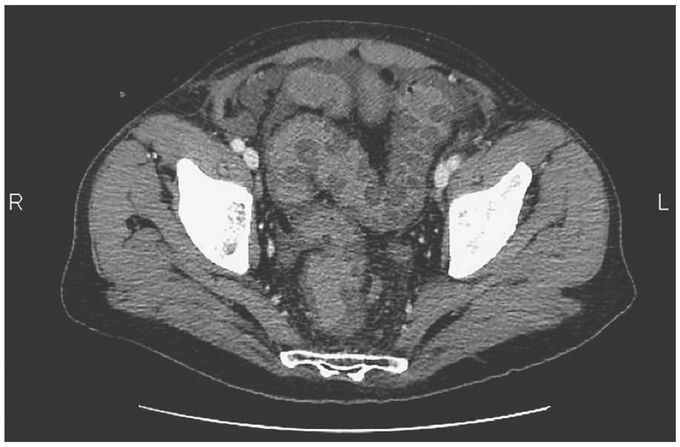 Thumbprinting in Ischemic Colitis