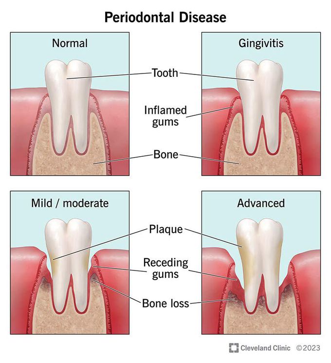 Periodontal disease