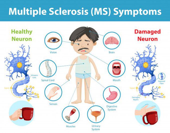 Symptoms of Multiple sclerosis
