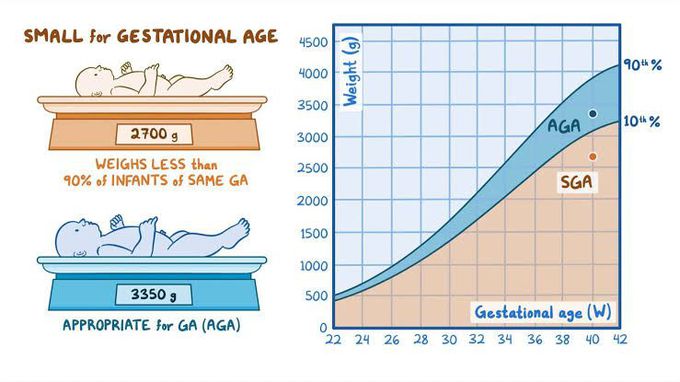Small For Gestational Age SGA MEDizzy