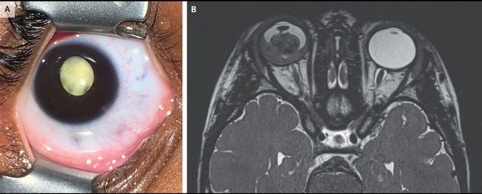 Retinoblastoma