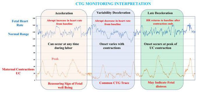 CTG monitoring Interpretation