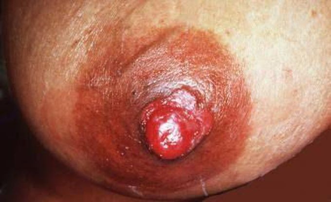 Symptoms of paget's disease of the nipple