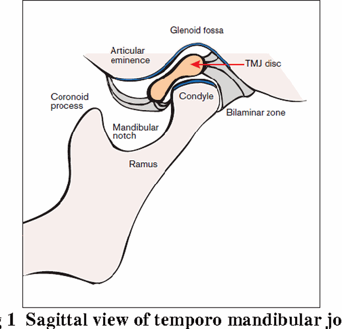Internal derangement of TMJ