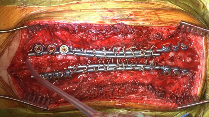 Growing rod construct for the treatment of early-onset scoliosis. 