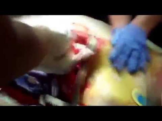 Resuscitative Thoracotomy