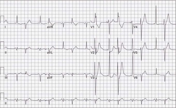 There are 3 findings in this ECG, who can find them out??????