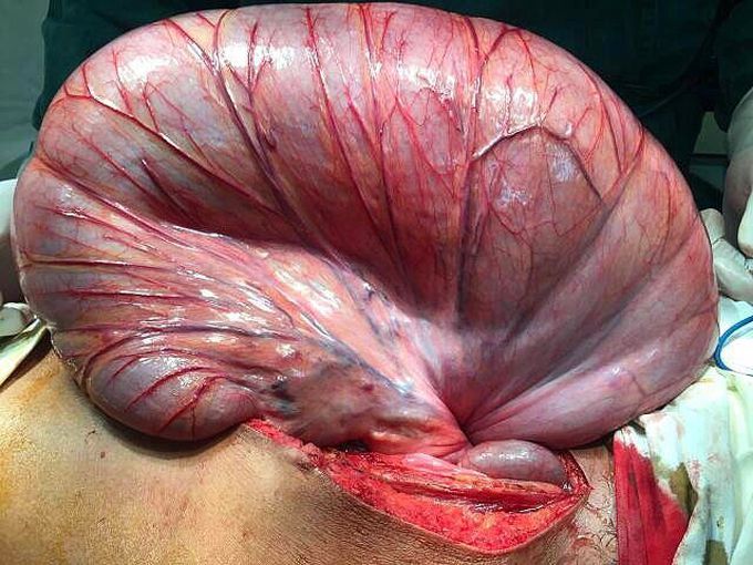 Colon twisted around itself!  