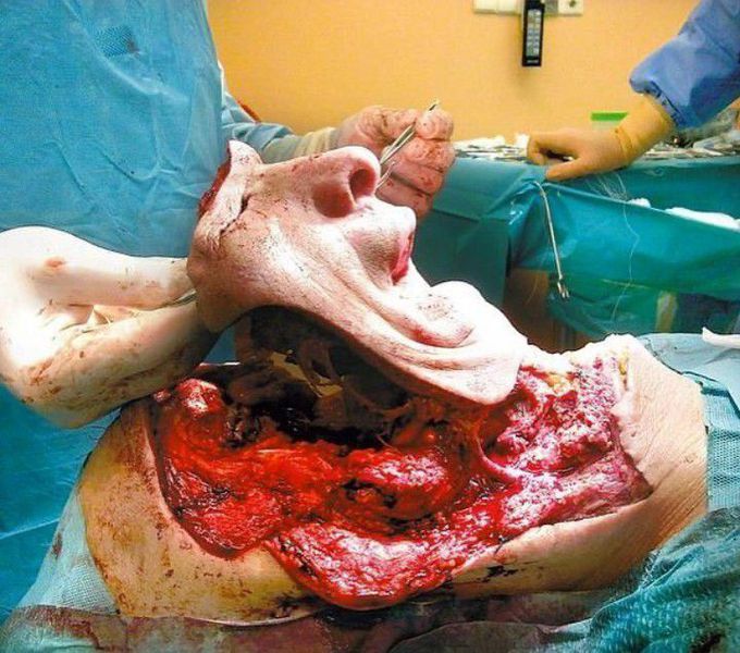 Face Transplant