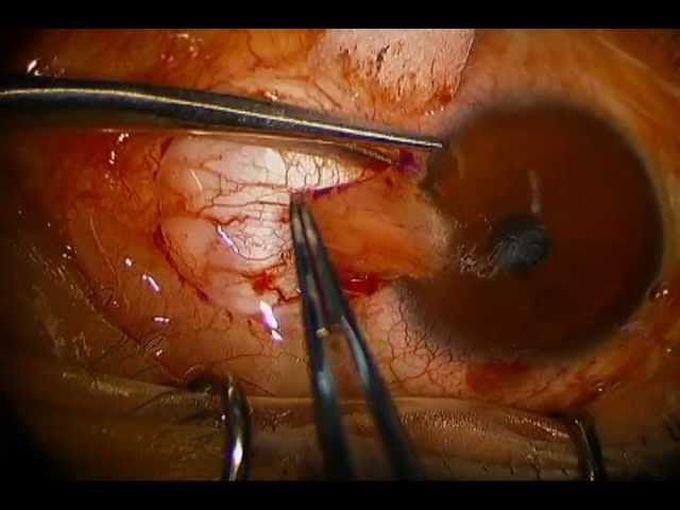 Pterygium Excision with Conjunctival Autograft