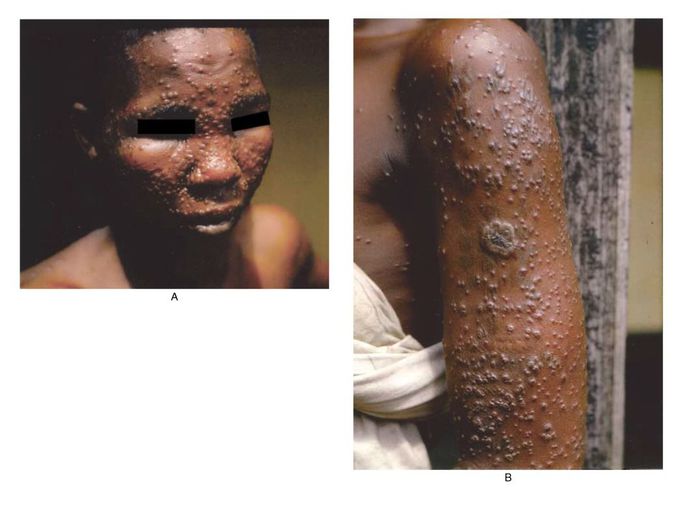 Smallpox
