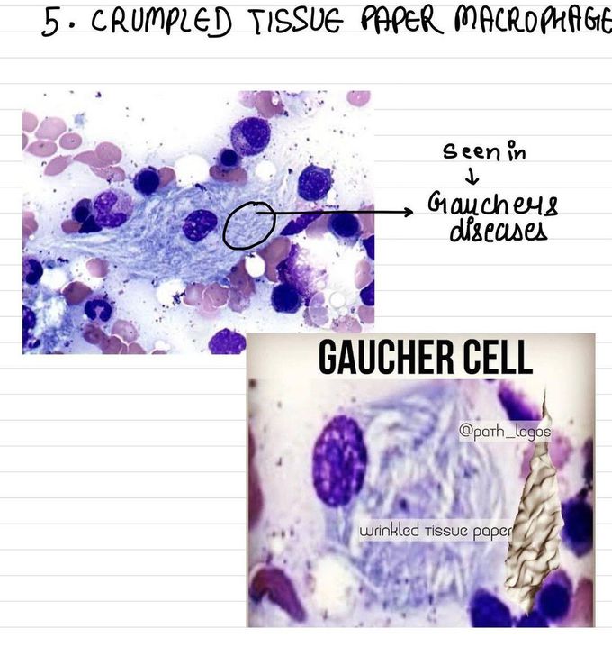 Gaucher Cell