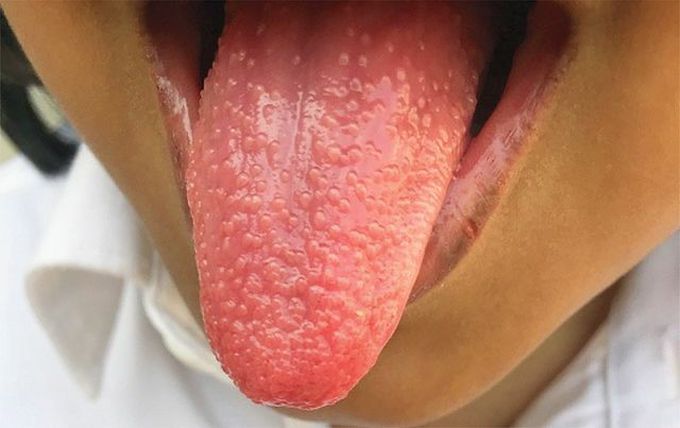 Strawberry tongue seen in Scarlet fever 😱