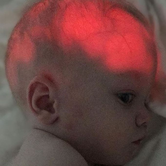 Neonatal HSV Encephalitis