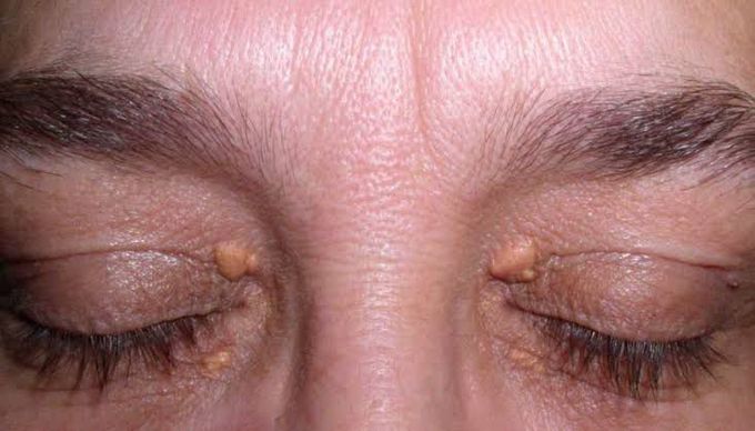 Xanthelasma palpebrarum