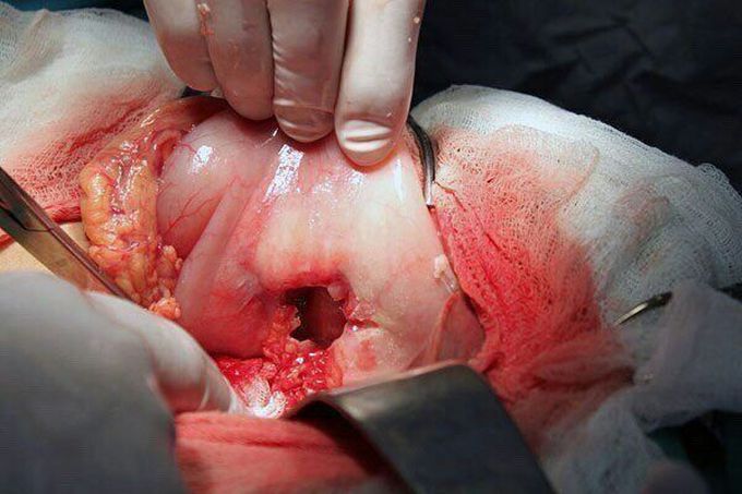 Perforated stomach ulcer.