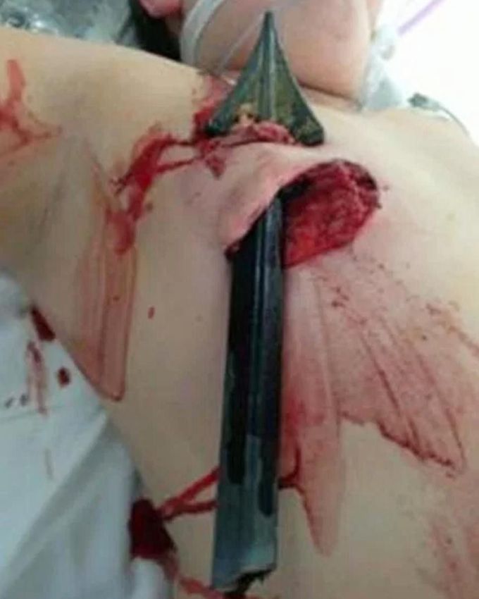 A 12-year-old British boy is lucky to be alive after a fence spike went through his chest.