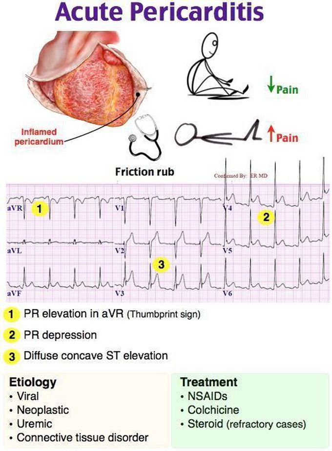 Acute Pericarditis!