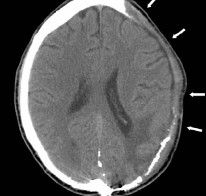 Craniectomy