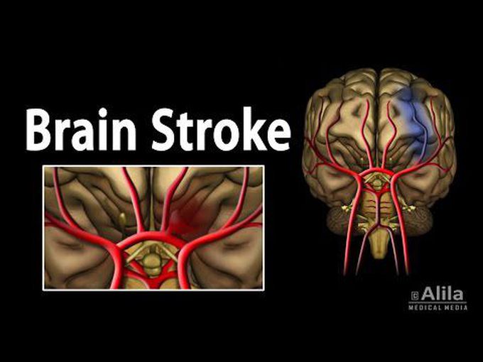 Cerebral Stroke (Animation)
