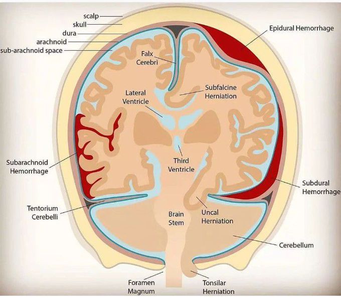 Imtracranial Hemorrhage