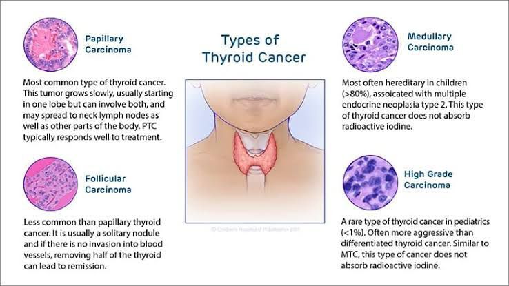 Types Of Thyroid Cancer MEDizzy