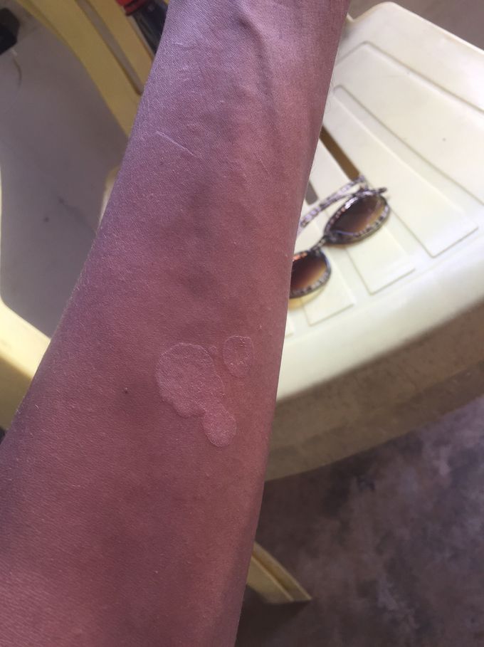Skin problems.