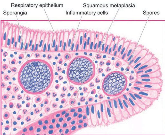 Rhinosporidiosis in a nasal polyp.