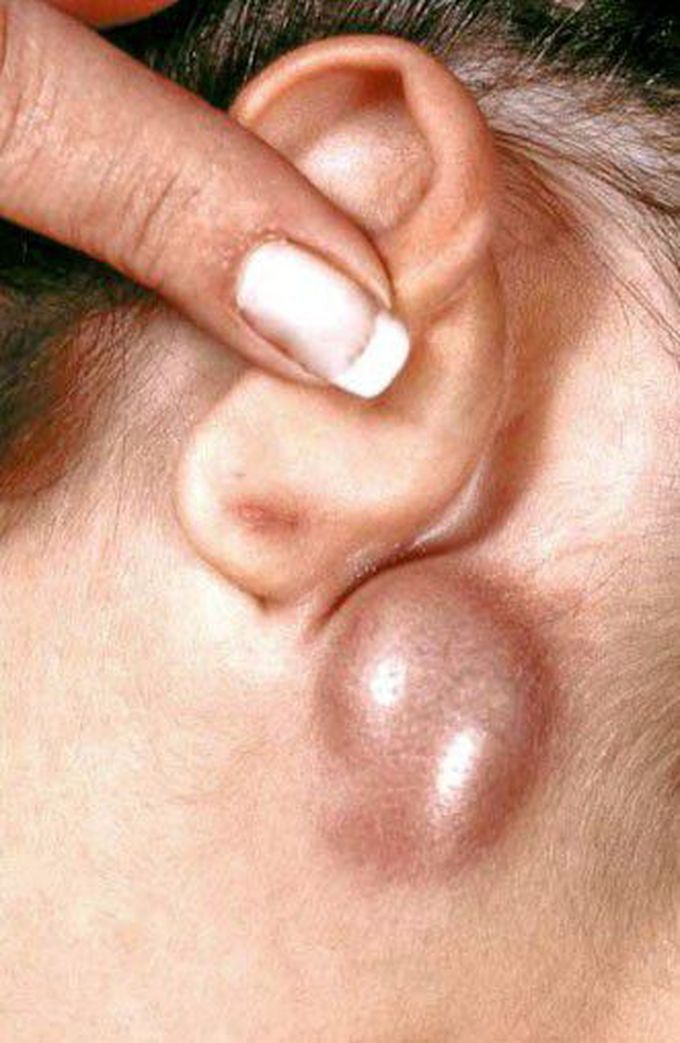 Cat scratch disease
