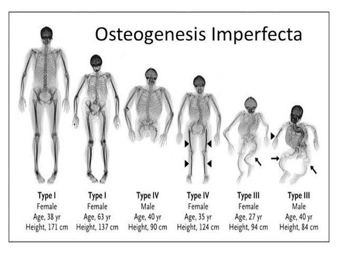 Osteogenesis Imperfecta, is also known as: