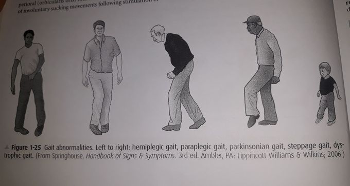 Gait abnormalities