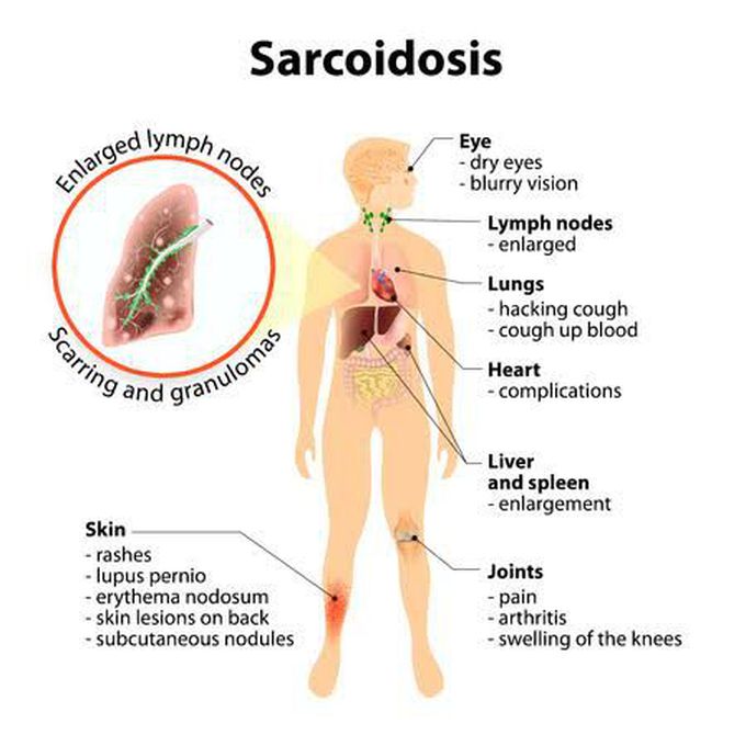 Complications of sarcoidosis