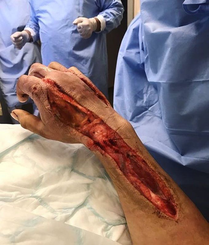 Necrotizing fasciitis of the hand