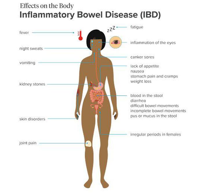 Inflamatory bowel disease