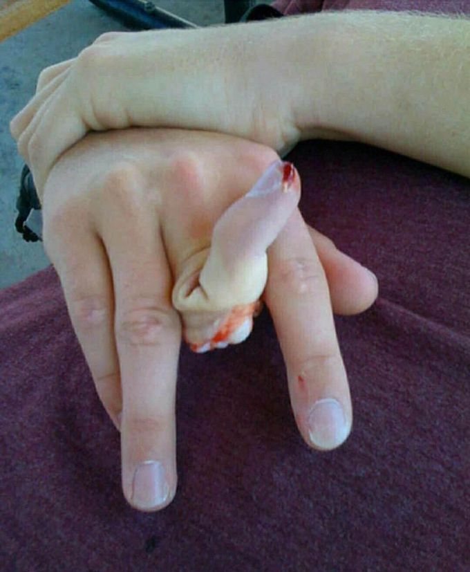 Open dorsal dislocation of the proximal interphalangeal (PIP) joint with an associated fracture 
