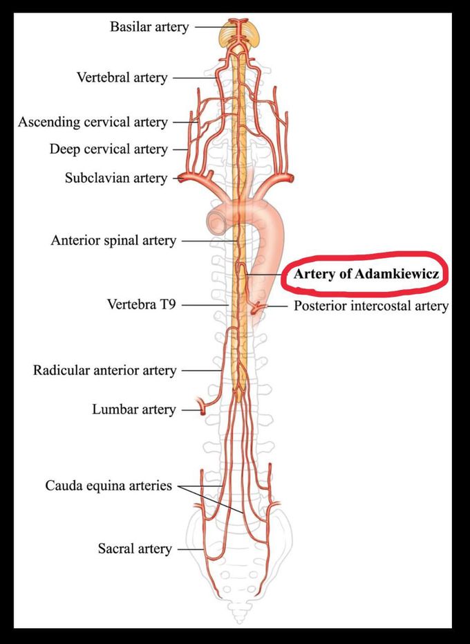 What is Adamkiewicz artery?                                    It’s an artery that when severed can lead to Anterior spinal syndrome ; can be severed in abdominal aortic aneurysm repair.