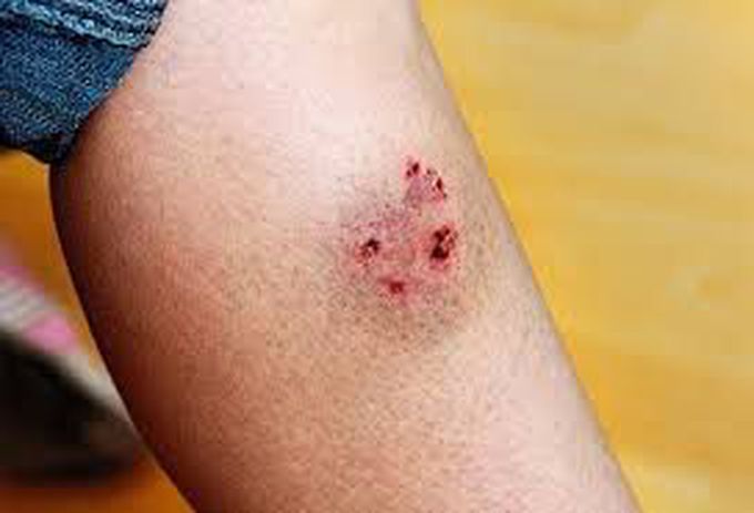Punture wound