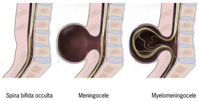 Meningocele vs myelomeningocele