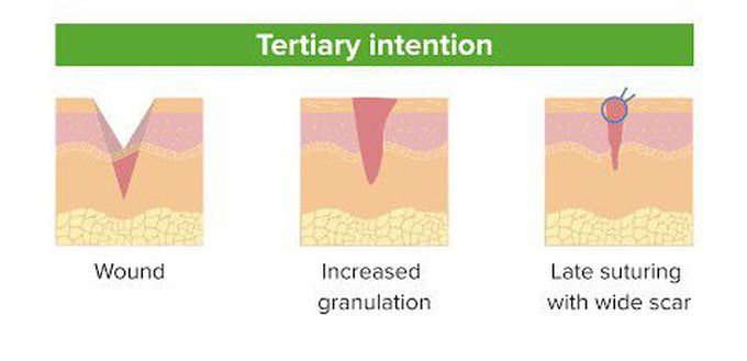 Tertiary intention of wound healing