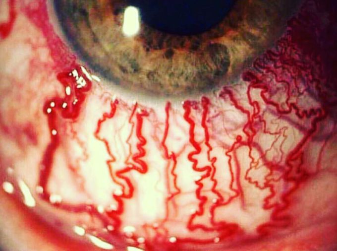 Cool photograph of a bloodshot eye!